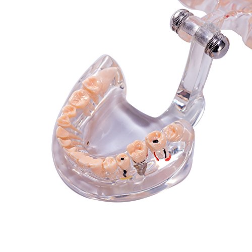 Модел патология на зъбите SNAWOP с Импланти и Болести на Зъбите Прозрачен Стандартна паста за Типодонт за обучение