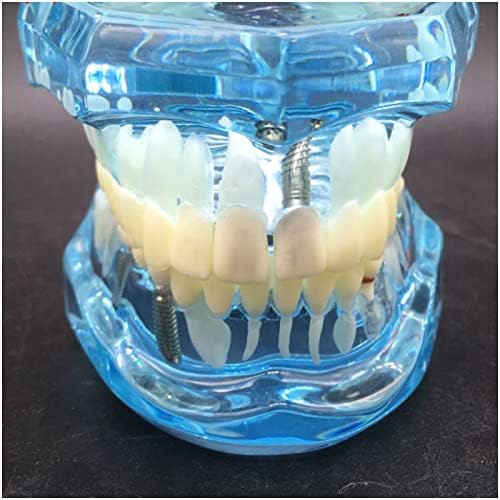 Кристален Патологична модел на зъба KH66ZKY - Модел за Възстановяване на Импланти - за Обучение на деца, Зъболекар,