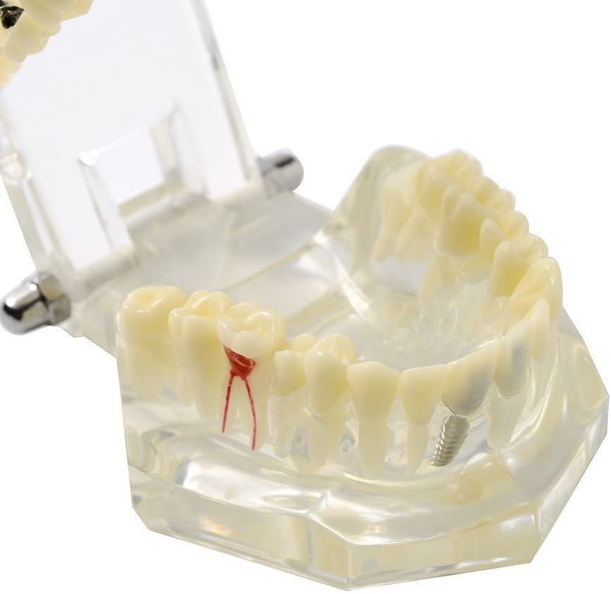 Модел на Зъбен имплант SNAWOP Модел Прозрачни Зъбите при Заболяване на Модел на Болестно Зъб с Подвижни Зъби, за да